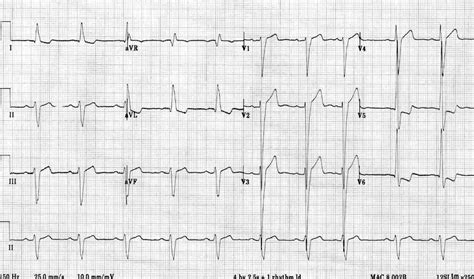 lv strain pattern on ecg|left ventricular hypertrophy on ecg.